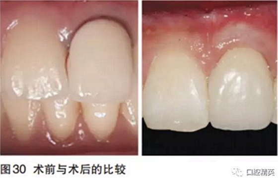 前牙即刻种植并个性化基台美学修复