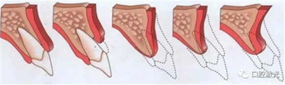 激光辅助牙槽嵴保存技术 激光辅助牙槽嵴保存技术