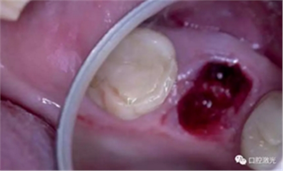 激光辅助牙槽嵴保存技术 激光辅助牙槽嵴保存技术