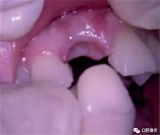 激光辅助牙槽嵴保存技术 激光辅助牙槽嵴保存技术