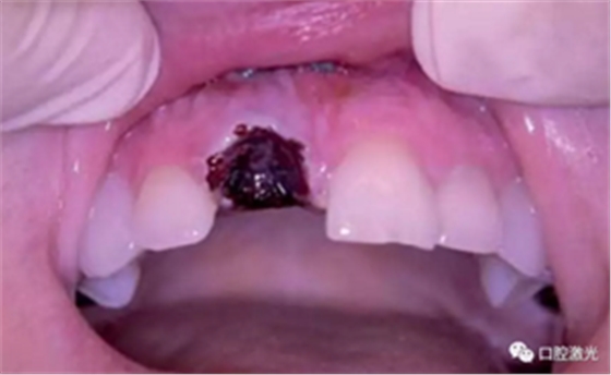 激光辅助牙槽嵴保存技术 激光辅助牙槽嵴保存技术