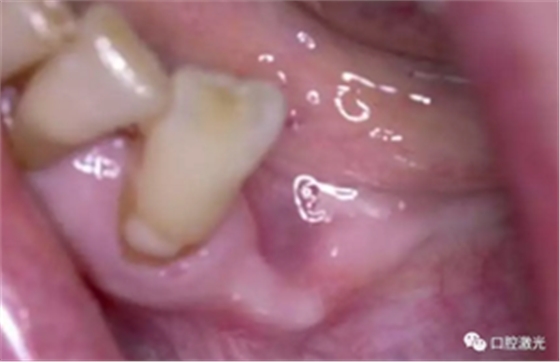 激光辅助牙槽嵴保存技术 激光辅助牙槽嵴保存技术