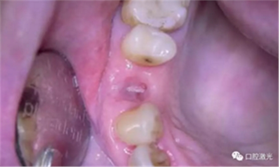 激光辅助牙槽嵴保存技术 激光辅助牙槽嵴保存技术