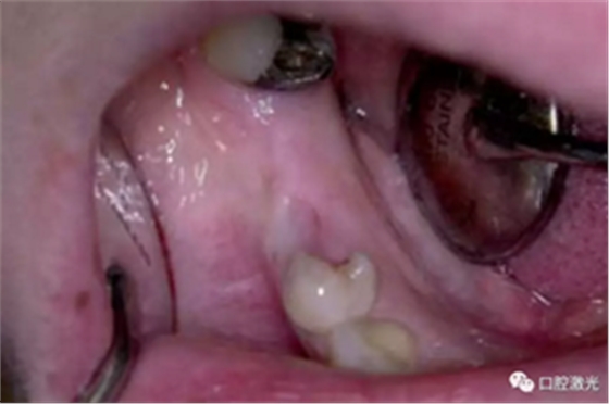 激光辅助牙槽嵴保存技术 激光辅助牙槽嵴保存技术