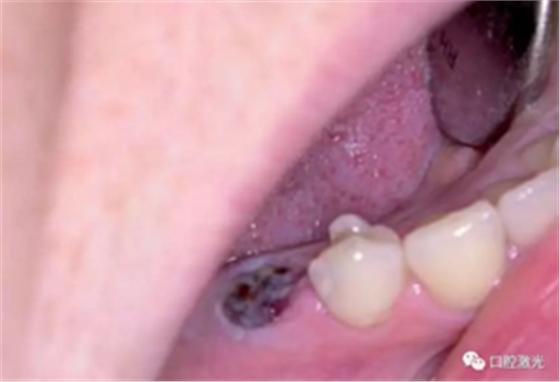 激光辅助牙槽嵴保存技术 激光辅助牙槽嵴保存技术