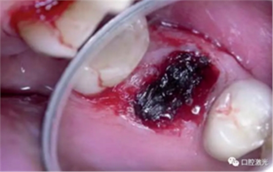 激光辅助牙槽嵴保存技术 激光辅助牙槽嵴保存技术