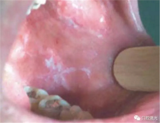 半导体激光软组织焊接治疗糜烂型扁平苔藓