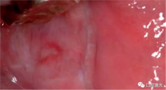 半导体激光软组织焊接治疗糜烂型扁平苔藓