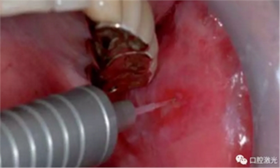 半导体激光软组织焊接治疗糜烂型扁平苔藓