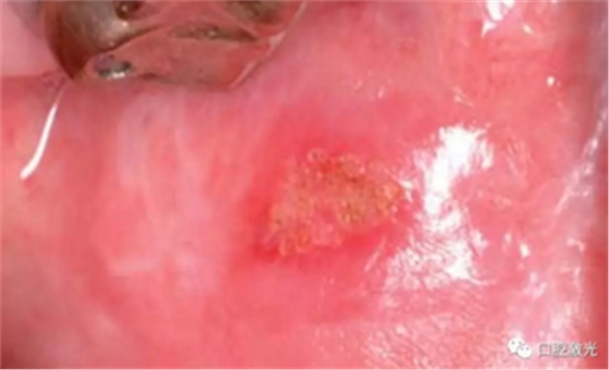 半导体激光软组织焊接治疗糜烂型扁平苔藓