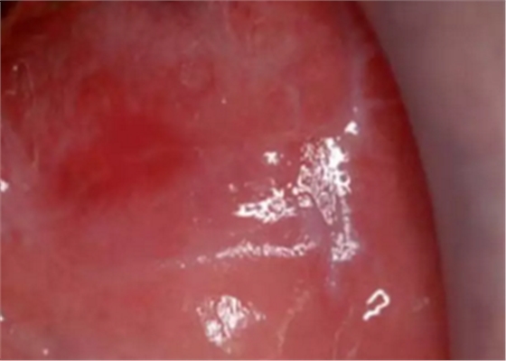 半导体激光软组织焊接治疗糜烂型扁平苔藓