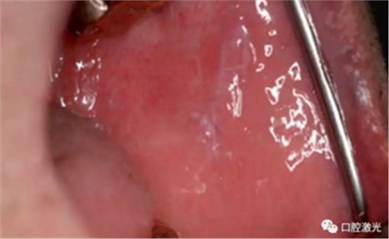 半导体激光软组织焊接治疗糜烂型扁平苔藓