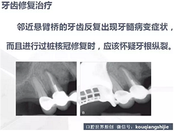 牙根纵裂