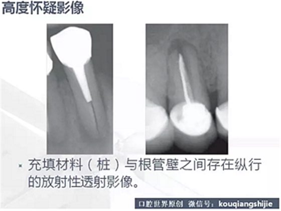 牙根纵裂