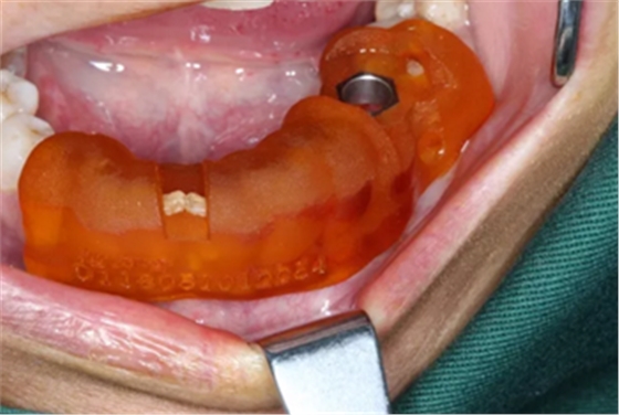 【病例分享】Implant Guide?数字化全程导航及椅旁即刻修复一例