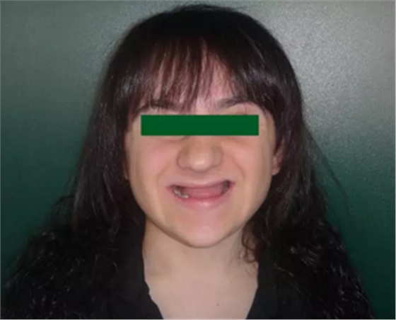 病例讨论:釉质发育不全 1 例 病例讨论:釉质发育不全 1 例