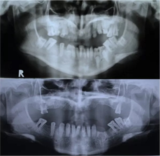 病例讨论:釉质发育不全 1 例 病例讨论:釉质发育不全 1 例
