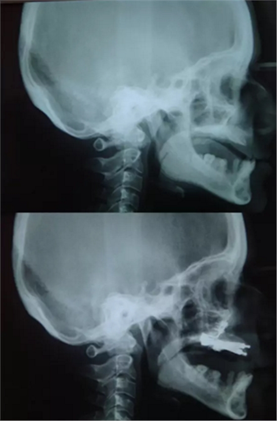 病例讨论:釉质发育不全 1 例 病例讨论:釉质发育不全 1 例