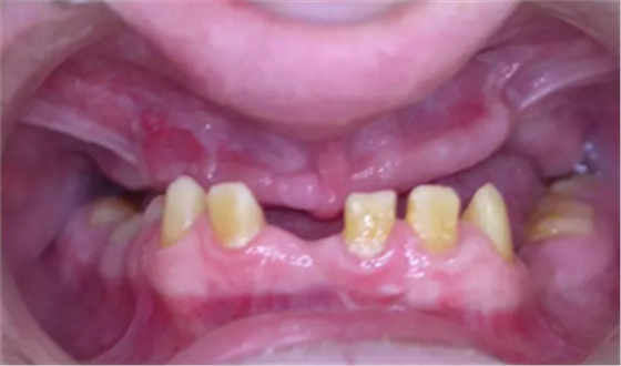 病例讨论:釉质发育不全 1 例 病例讨论:釉质发育不全 1 例