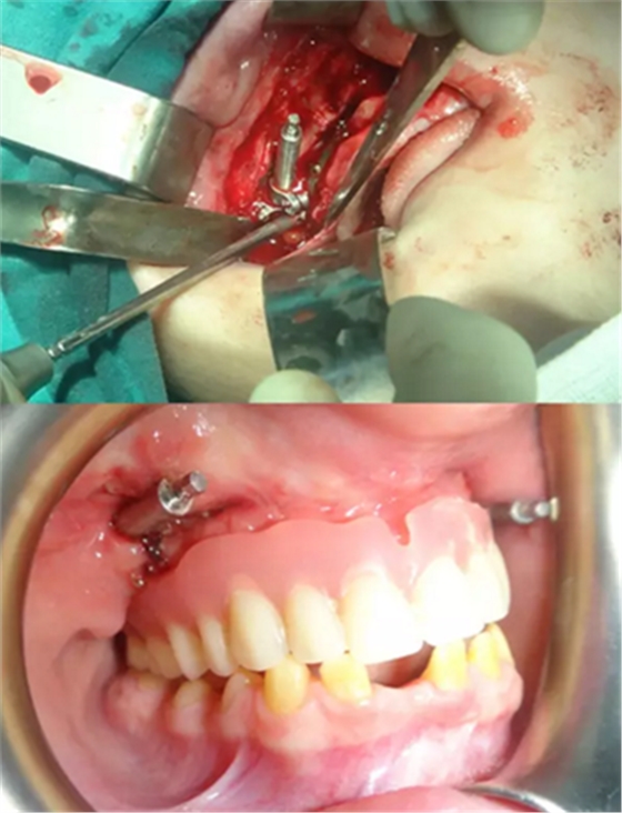 病例讨论:釉质发育不全 1 例 病例讨论:釉质发育不全 1 例