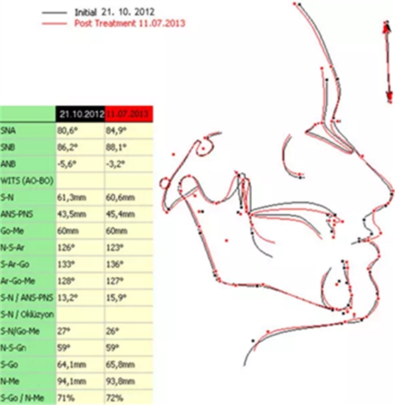病例讨论:釉质发育不全 1 例 病例讨论:釉质发育不全 1 例