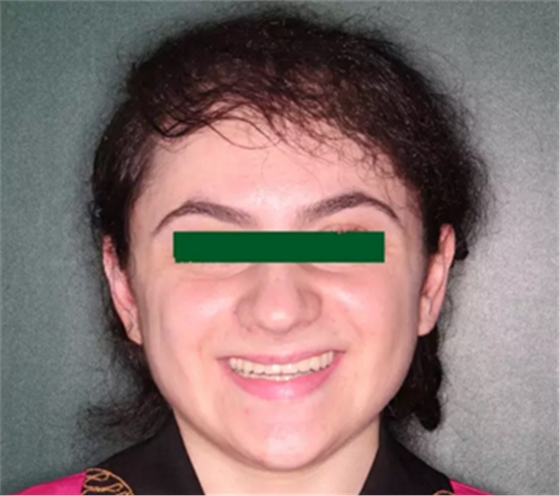 病例讨论:釉质发育不全 1 例 病例讨论:釉质发育不全 1 例