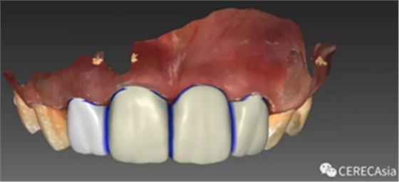 临床案例分享-多层次氧化锆的时代已经到来！