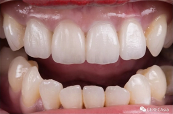 臨床案例分享-拆除原有金瓷冠，恢复病人美观自信