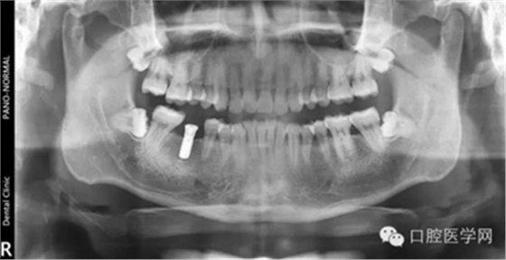 如何在X光片上判断种植体的品牌
