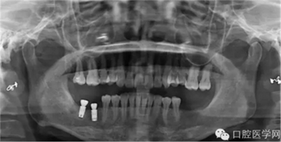 如何在X光片上判断种植体的品牌