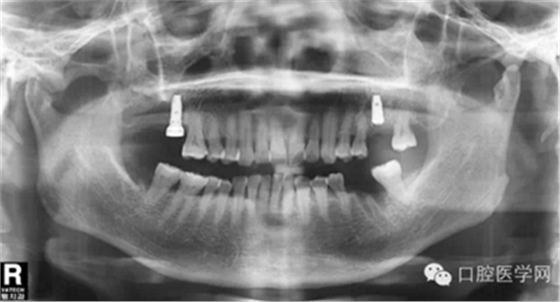 如何在X光片上判断种植体的品牌