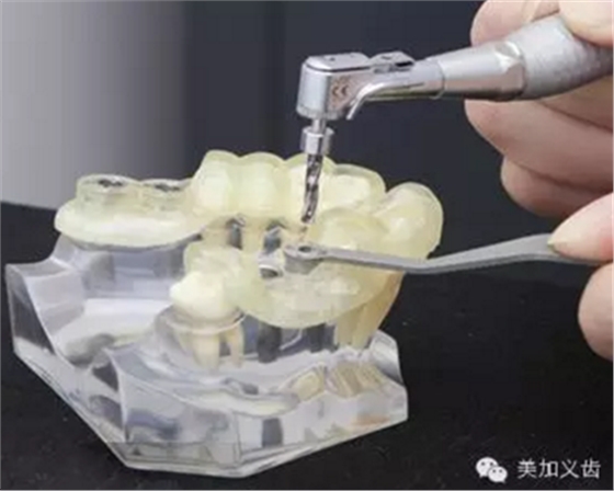 牙技术丨牙科种植导板在临床中的应用