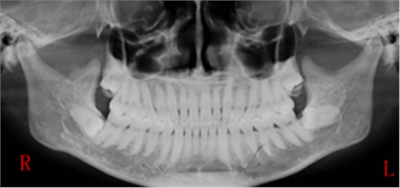 [颌面外科] 赵吉宏教授教你分析阻生牙阻力及画分冠线