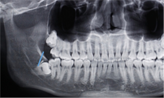 [颌面外科] 赵吉宏教授教你分析阻生牙阻力及画分冠线