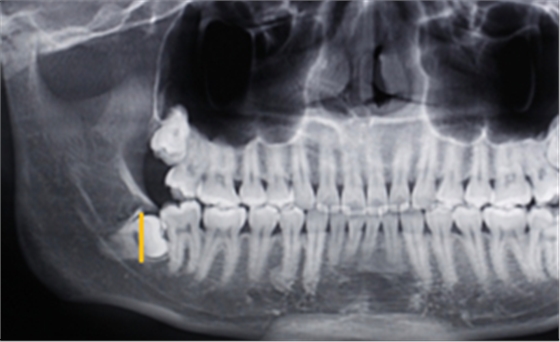[颌面外科] 赵吉宏教授教你分析阻生牙阻力及画分冠线