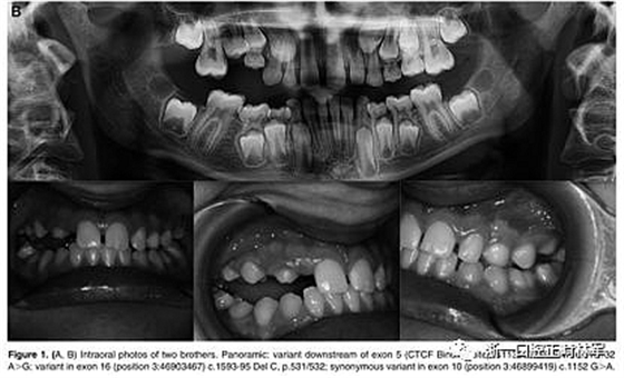 正畸文献阅读--原发性萌出失败:混合牙列的临床和遗传学研究 正畸文献阅读--原发性萌出失败:混合牙列的临床和遗传学研究