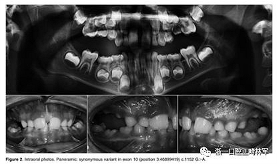 正畸文献阅读--原发性萌出失败:混合牙列的临床和遗传学研究 正畸文献阅读--原发性萌出失败:混合牙列的临床和遗传学研究