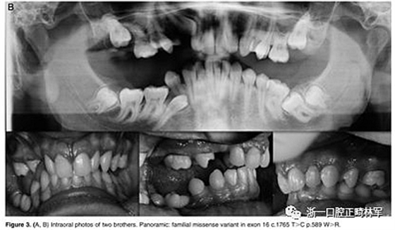 正畸文献阅读--原发性萌出失败:混合牙列的临床和遗传学研究 正畸文献阅读--原发性萌出失败:混合牙列的临床和遗传学研究