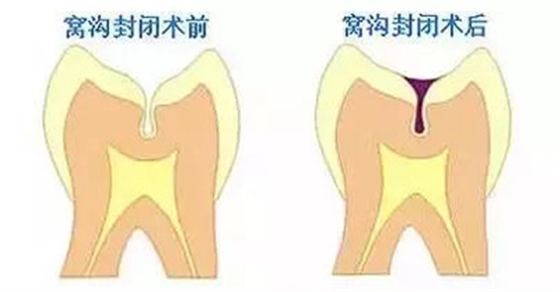 窝沟封闭丨孩子牙齿的“铠甲勇士”