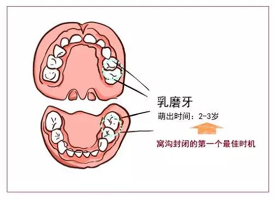 窝沟封闭丨孩子牙齿的“铠甲勇士”