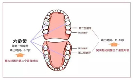 窝沟封闭丨孩子牙齿的“铠甲勇士”