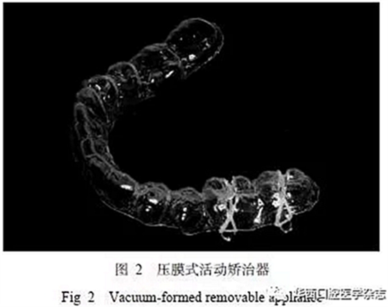 利用压膜式活动矫治器压入下颌第一、第二磨牙1例