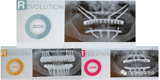 Paulo Malo &周国辉教授｜无牙颌种植修复的创新理念