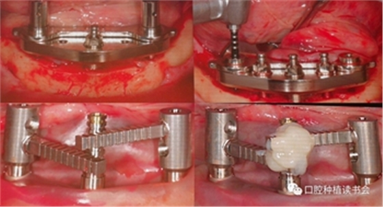 Paulo Malo &周国辉教授｜无牙颌种植修复的创新理念