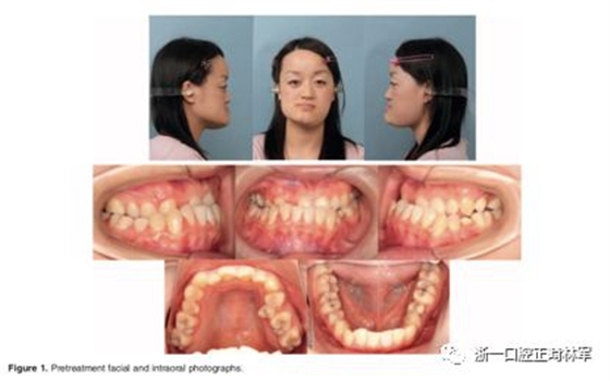 文献优秀正畸病例赏析-髁突增生性面部不对称的协同治疗1例