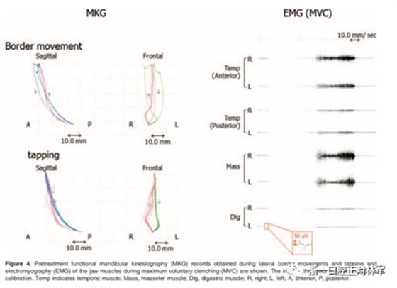 文献优秀正畸病例赏析-髁突增生性面部不对称的协同治疗1例