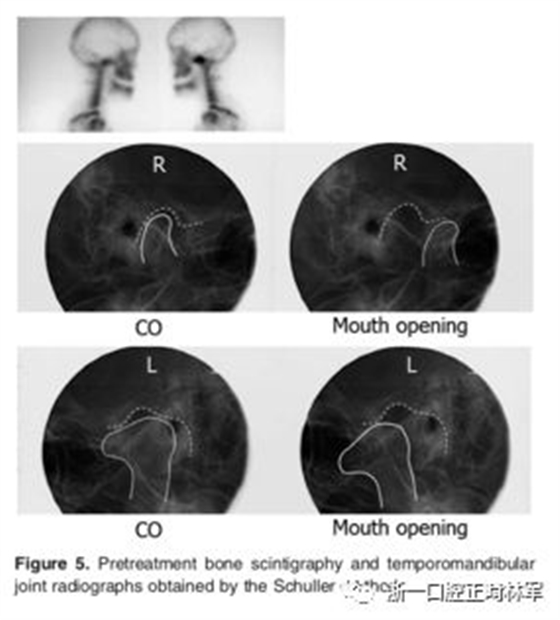 文献优秀正畸病例赏析-髁突增生性面部不对称的协同治疗1例
