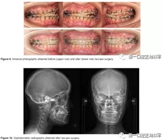 文献优秀正畸病例赏析-髁突增生性面部不对称的协同治疗1例