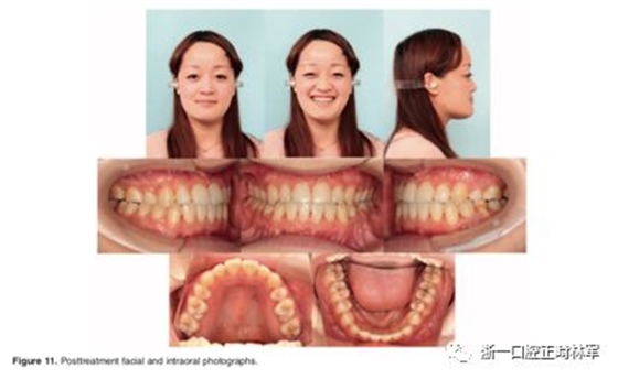 文献优秀正畸病例赏析-髁突增生性面部不对称的协同治疗1例