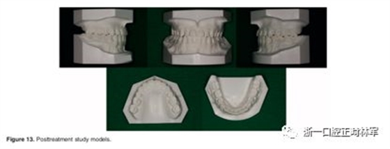 文献优秀正畸病例赏析-髁突增生性面部不对称的协同治疗1例